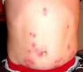 Skin marks pictured in the original article on bed bugs